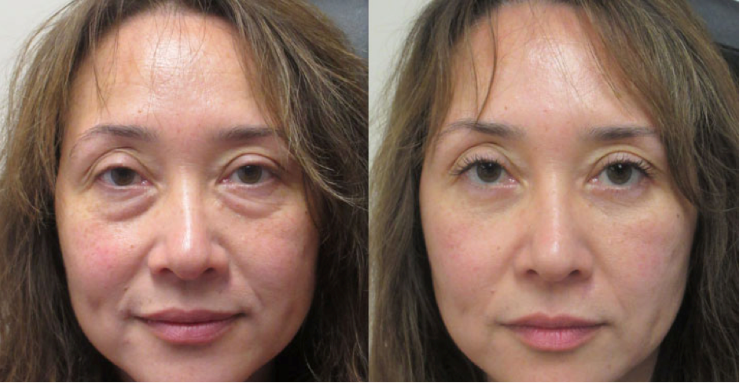 Linda M. — before and after